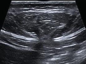 Epigastric hernia.jpg