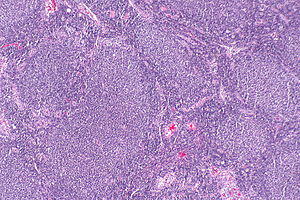 Follicular lymphoma -- low mag.jpg