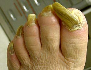 ONYCHOGRYPHOSIS1.JPG