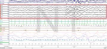 Stage N1 Sleep. EEG highlighted by red box.