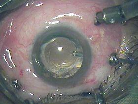 Vitrectomy-23g.jpg