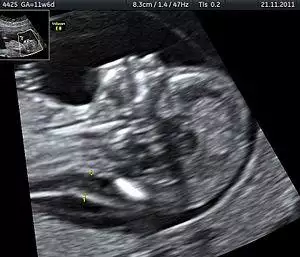 Nuchal edema in Down Syndrome Dr. W. Moroder.jpg