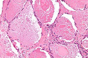 Pulmonary alveolar proteinosis -3- high mag.jpg
