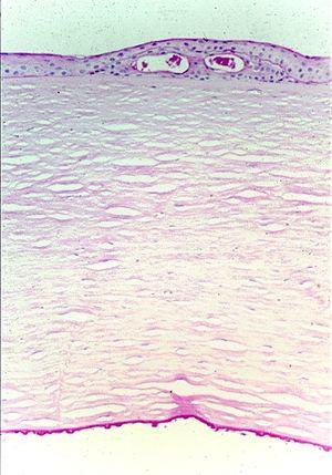 Fuchs dystrophy 1.JPG