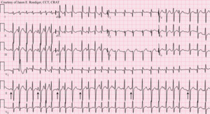 Multifocal atrial tachycardia - MAT.png
