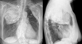 Oleothorax bei Tuberkulose 80jw - Roe ap und seitlich - 001.jpg