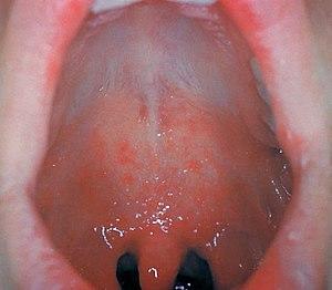 Measles enanthema.jpg