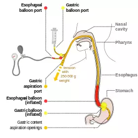 Sengstaken-Blakemore scheme EN.svg