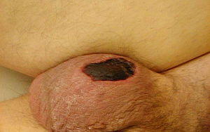 Furnijerova gangrena.jpg