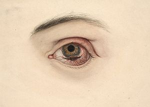 Eye with a melanotic sarcoma Wellcome L0061861.jpg