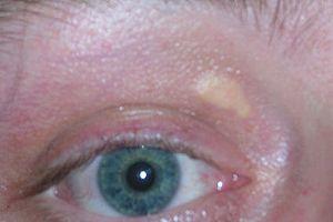Xanthelasma palpebrarum.jpg