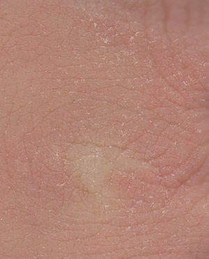 Xeroderma knuckles.jpg