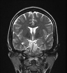 Mesial Temporal Sclerosis.jpg