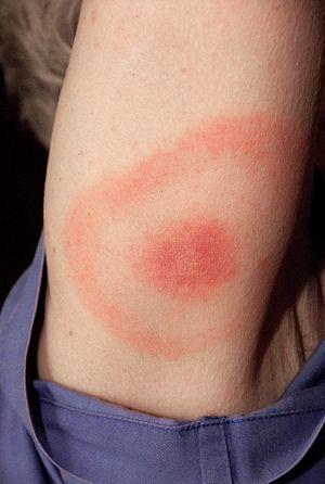 Erythema migrans - erythematous rash in Lyme disease - PHIL 9875.jpg