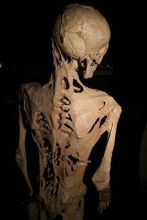 Fibrodysplasia ossificans progressiva.jpg