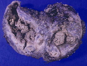 Aspergillomas complicating tuberculosis.jpg