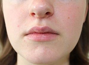 Periorale Dermatitis.jpg
