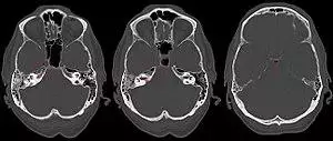 Apicitis petrosa 85jm - CT axial KF 3 Schichten - 001 - Annotation.jpg