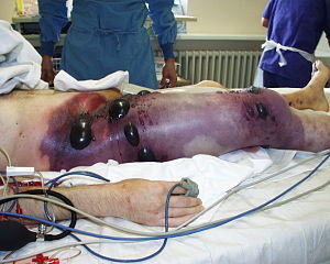 Gas gangrene.jpg