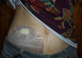 Ileostomy 2016-09-09 4158.jpg
