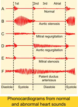 Phonocardiograms from normal and abnormal heart sounds.png