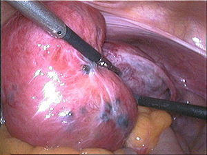 Adenomyosis.jpg