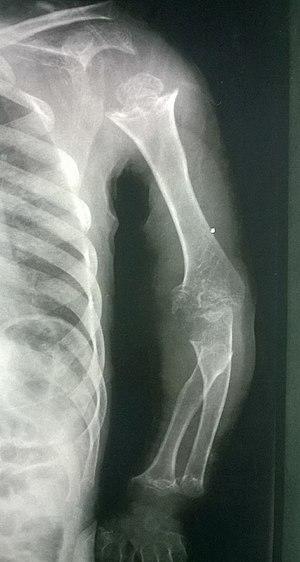 Pseudoachondroplasia. 01.jpg