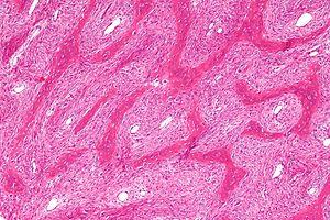 Fibrous dysplasia - intermed mag.jpg