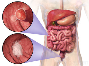 Blausen 0246 ColorectalCancer.png