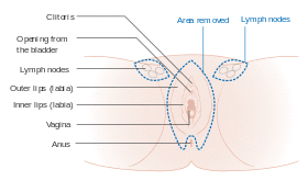 Diagram of a 3 in 1 incision vulvectomy CRUK 018.svg