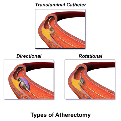 Blausen 0064 Atherectomy.png