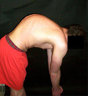 Scheuermanns diseasebl.jpg