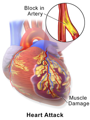 Blausen 0463 HeartAttack.png