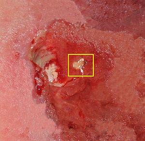 Decubitus ulcer stage 4.jpg
