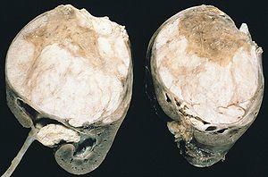 Wilms tumor.jpg