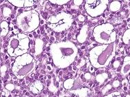Micrograph of adenoid cystic carcinoma.jpg