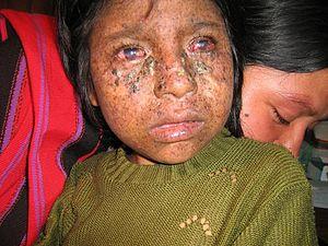 Xeroderma pigmentosum 02.jpg