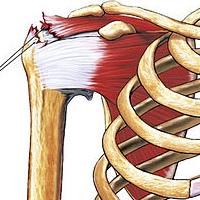 Rotator cuff tear.jpg