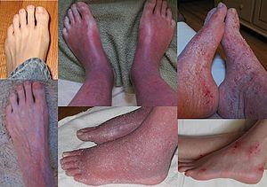 Red (burning) Skin Syndrome - Feet Collage.jpg
