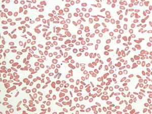 Hereditary elliptocytosis.jpg