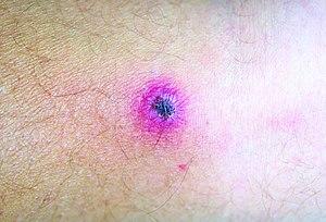 Rickettsialpox lesion.jpg