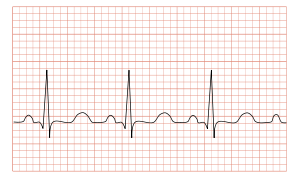 Tachycardia ECG paper.svg