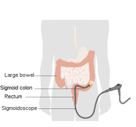 Diagram showing sigmoidoscopy.svg