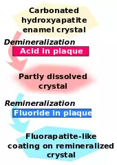 Carbonated hydroxyapatite enamel crystal is demineralized by acid in plaque and becomes partly dissolved crystal. This in turn is remineralized by fluoride in plaque to become fluorapatite-like coating on remineralized crystal