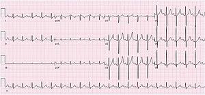 ECG Sinus Tachycardia 125 bpm.jpg
