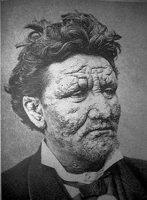Leprosy.jpg