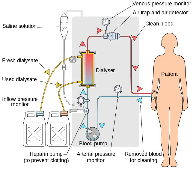 Hemodialysis-en.svg