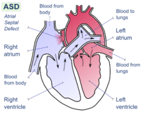 Diagram of the four chambers of the heart. There is a gap in the wall between the upper-left and upper-right chambers