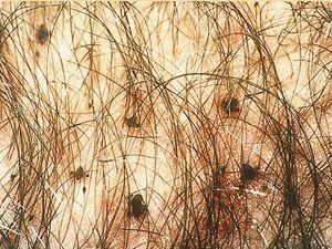 SOA-Pediculosis-pubis.jpg