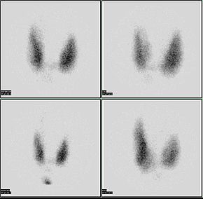Thyroid scan.jpg